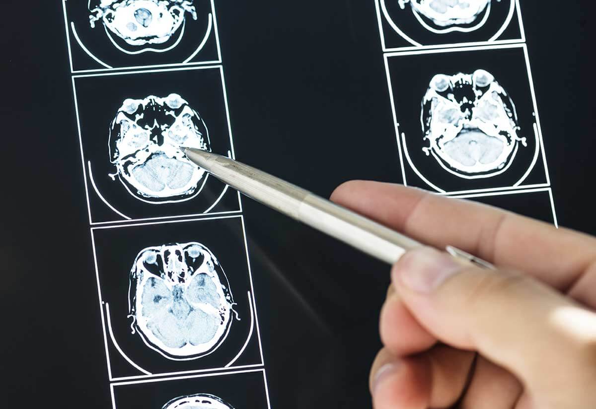 Reversing Memory Loss – 4 Things You Need To Know