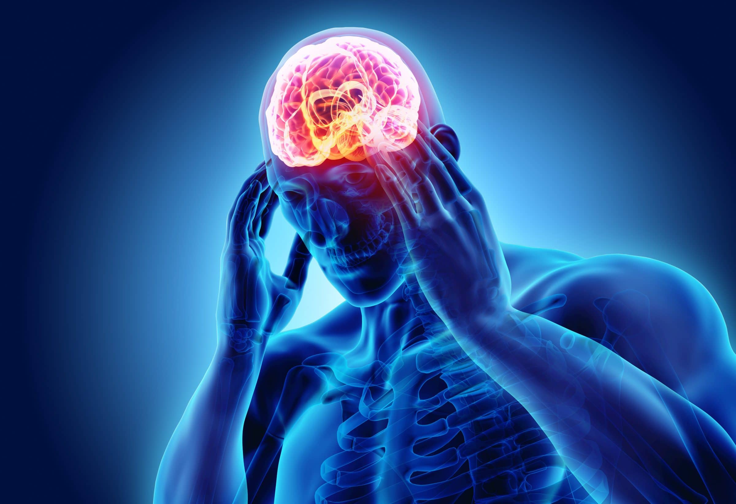 migraine-image Treating Chronic migraine with Functional Medicine