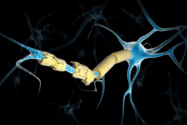 Conceptual image of a multiple sclerosis neuron.