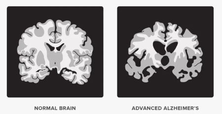 Early-Stage Alzheimer’s Disease