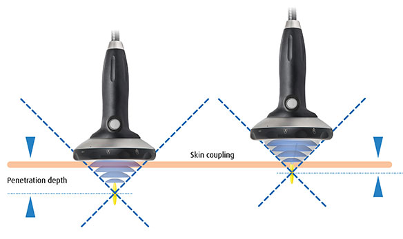 Shockwave technology