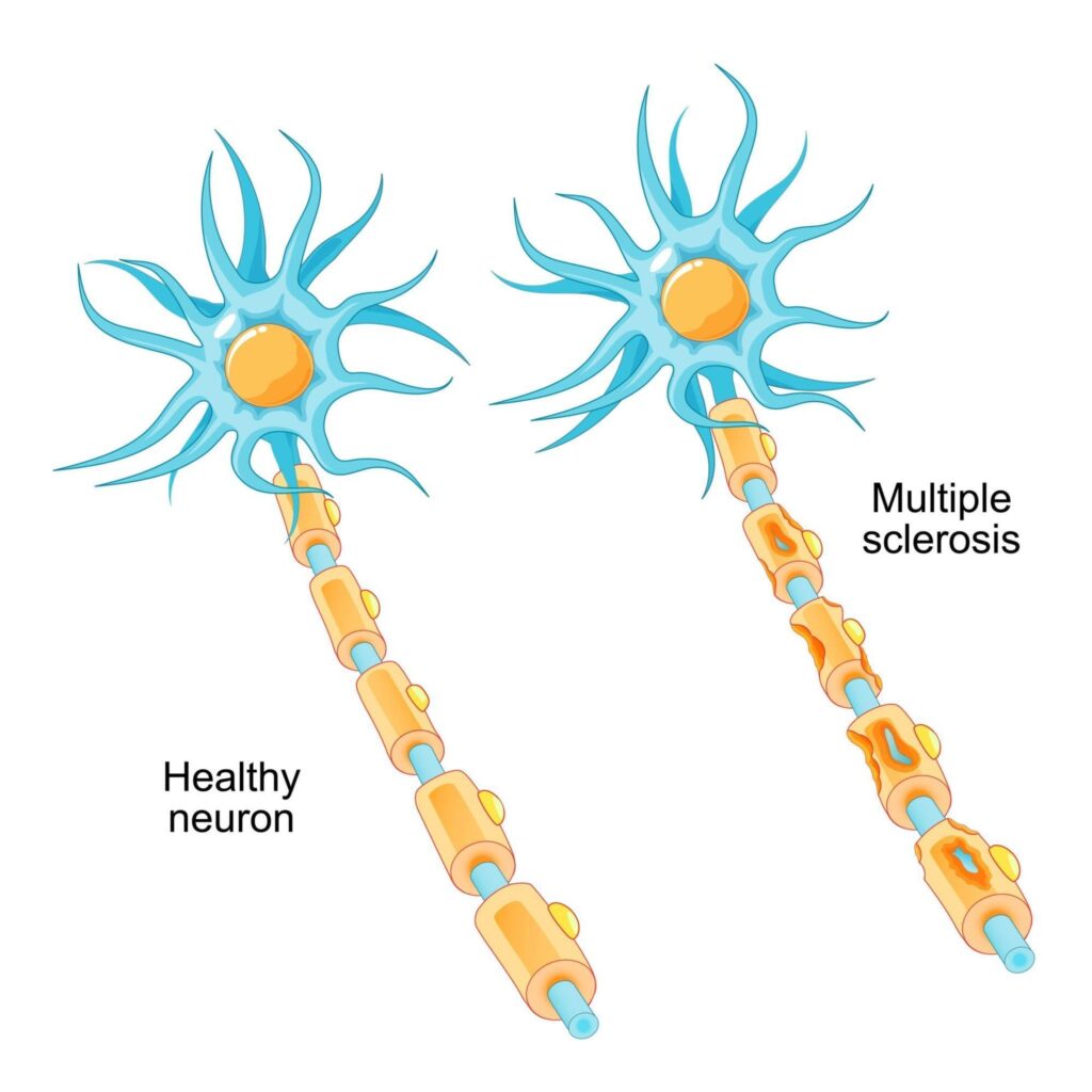 What Is Multiple Sclerosis